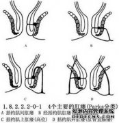 高低位肛瘺示意圖